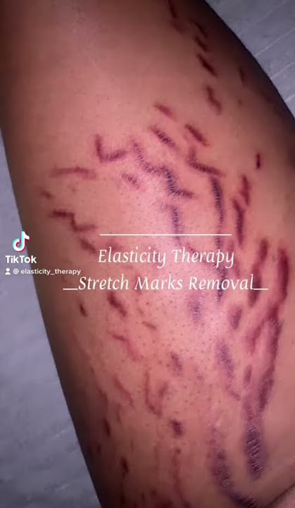 stretch marks treatment #stretchmarks #stretchmarksremoval