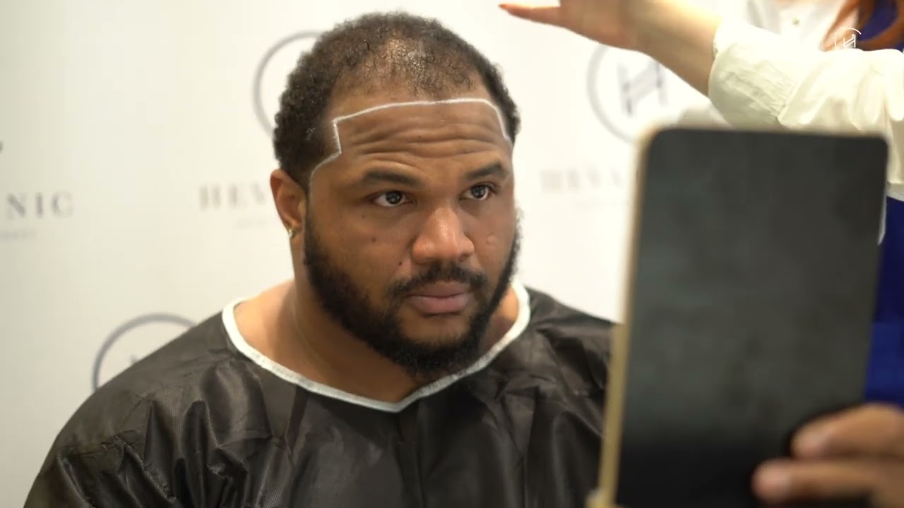 Afro Hair Transplant Journey - From the USA to Istanbul 