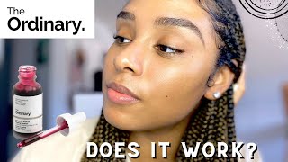 🤔I Tried The Ordinary for 90 days for My Hyperpigmentation | Non-Sponsored Review | Unbrelievable by Unbrelievable  379 views 3 years ago 15 minutes