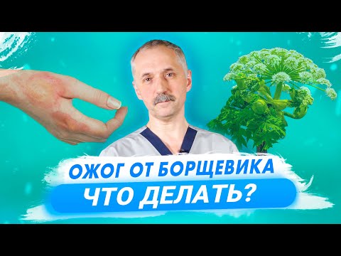 Химический ожог соком борщевика - как лечить? / Доктор Виктор