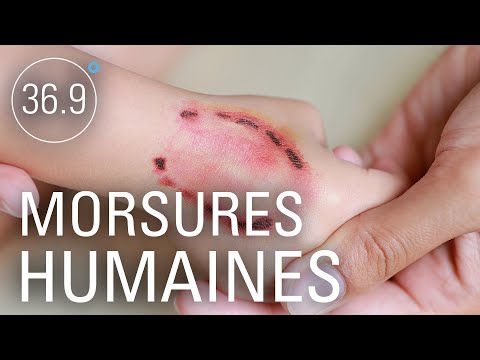 Vidéo: Comment traiter une morsure humaine : 15 étapes (avec photos)