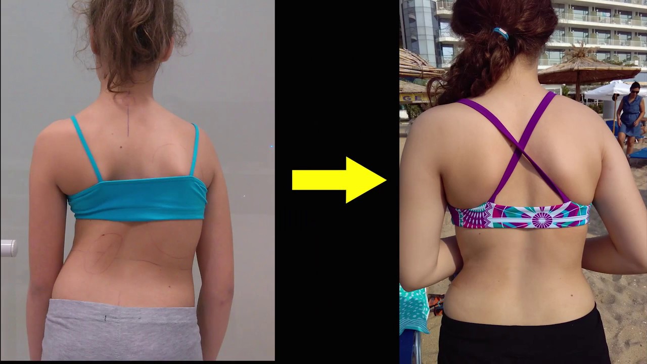 Advice and motivation for wearing your scoliosis brace YouTube