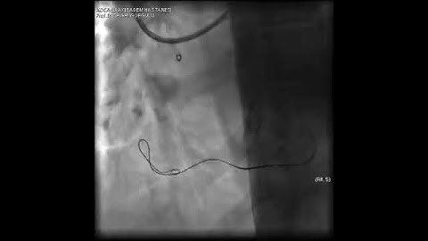 Aortic dissection and radial rupture during retrograde CTO PCI: Management of complications VİDEO 10