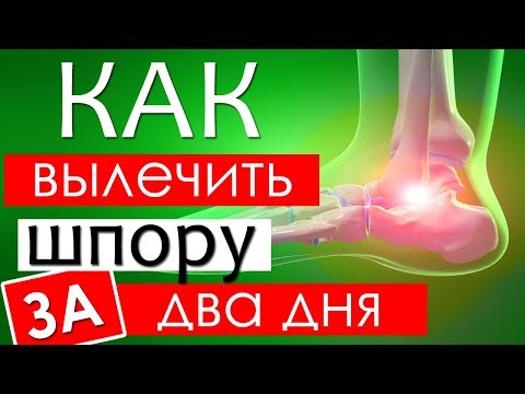 Как избавиться от шпоры на пятке в домашних условиях