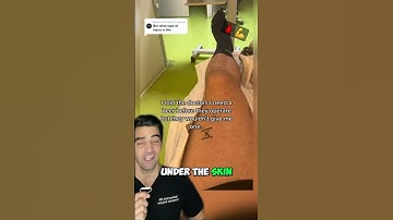 Hematoma Under the Skin