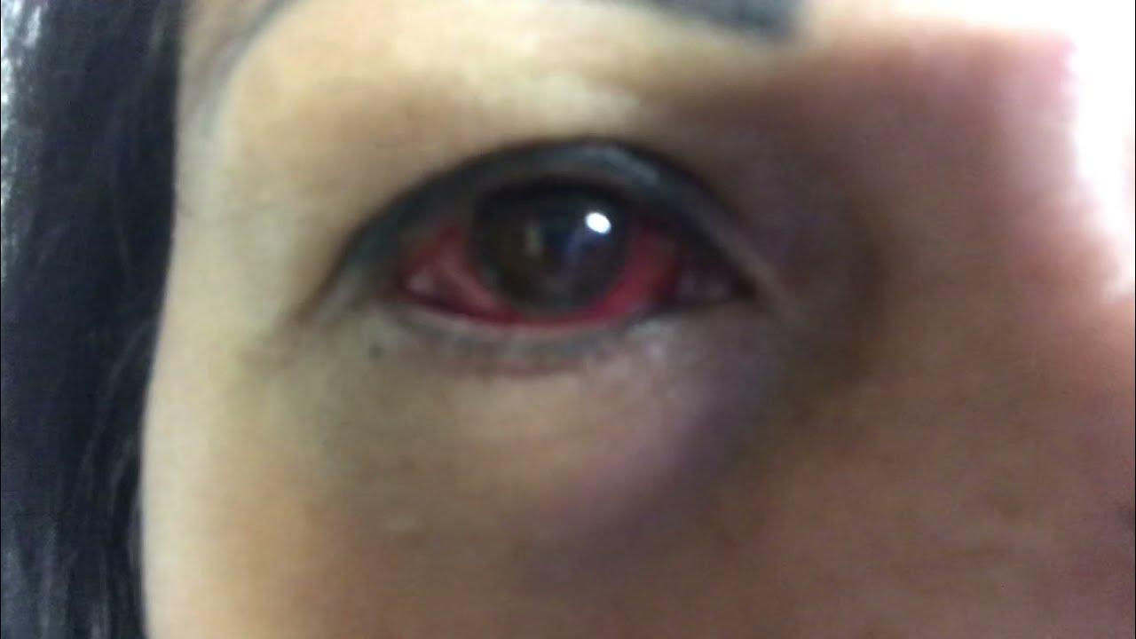 Why Is My Eyes Red RED EYE Anybody Can Tell Me What happen to My Eye YouTube