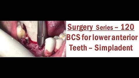 Simpladent BCS implants for lower anterior teeth extraction sockets