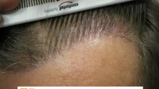 1551 FU's. Hair Transplant by FUE Technique. Injertocapilar.com. 25/2008