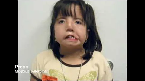 Free gracilis transfer for smile reanimation