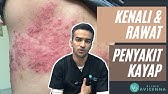 Betul Ke Kayap Ular Boleh Membawa Maut Penyakit Kayap Penyebab Simptom Komplikasi Dan Rawatan Youtube