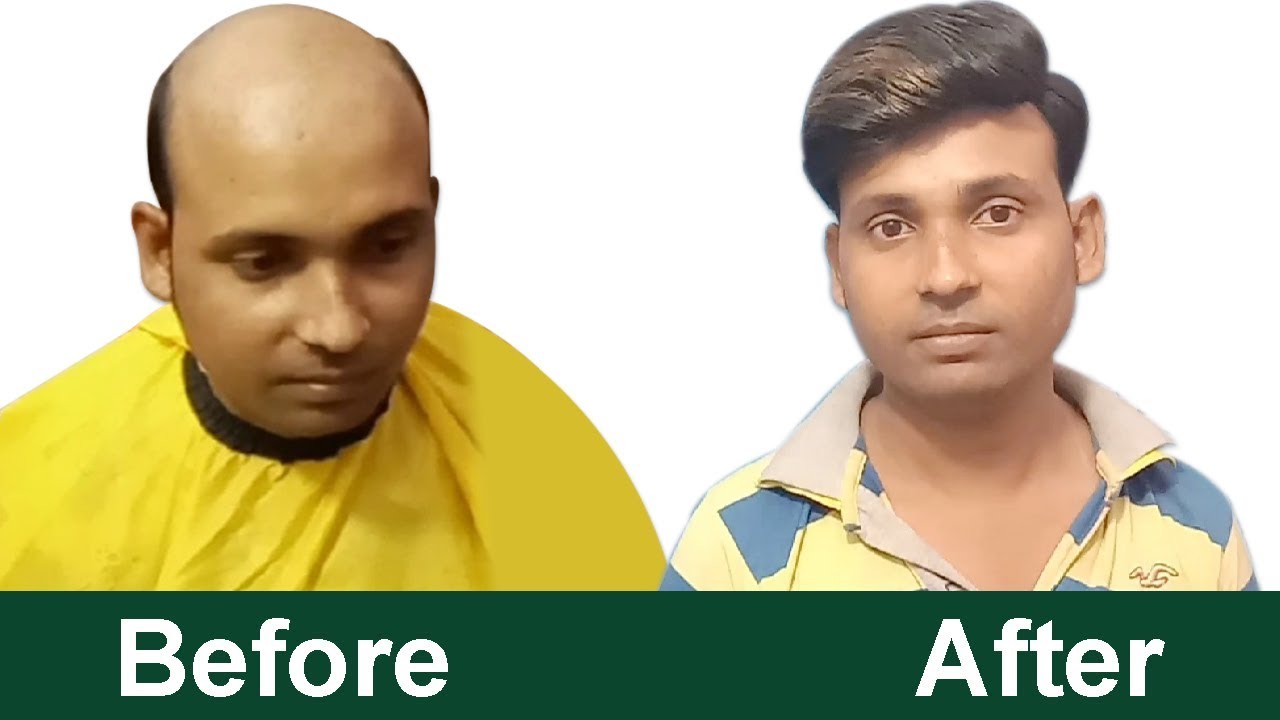 Hair Transplant in Lucknow || Non surgical hair transplant with best cost,  hair wig, patch - YouTube