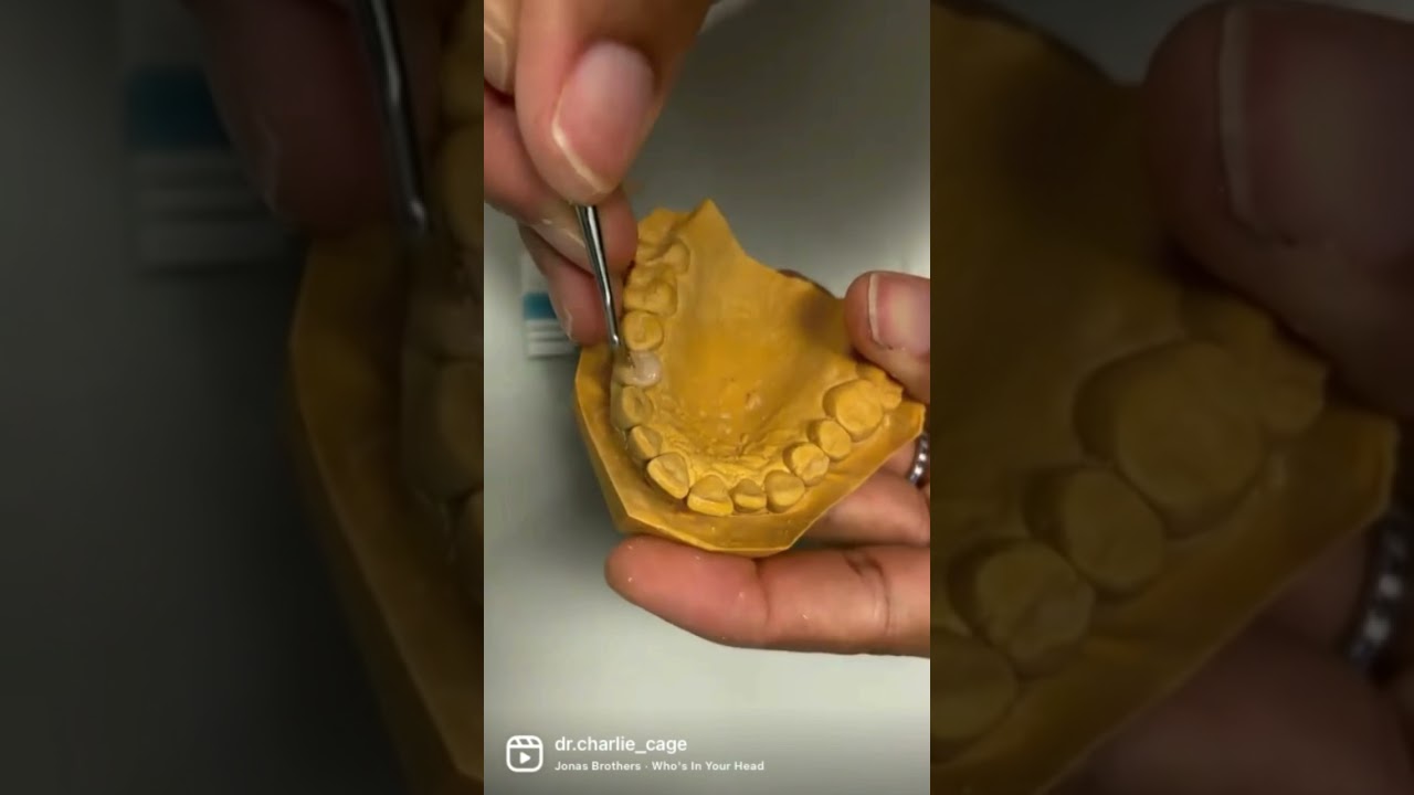 Waxing up missing anatomy for dental crown Dental Clinic