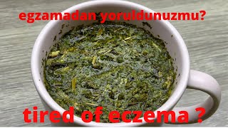 Download Lagu 1 haftada egzama, deri dermatiti ve alerjiler nasıl tedavi edilir MP3