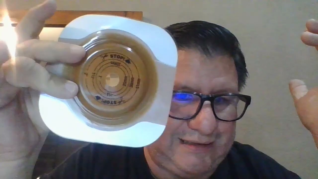 Quemaduras de la piel Ileostomía y Colostomía / Hablando de Ostomías con Marcelo.