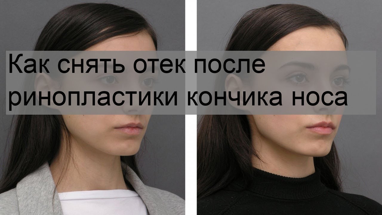 Как снять отек после ринопластики кончика носа