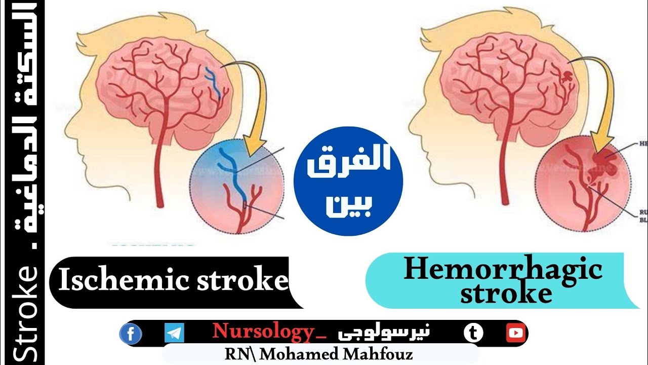 السكتة الدماغية - #stroke || الأنواع ،الاسباب ، الأعراض ،التشخيص و العلاج