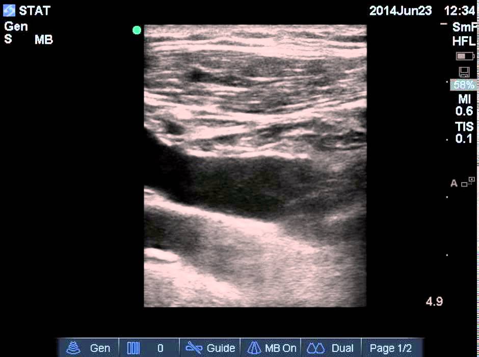 Ultrasound Guided Subclavian Vein Cannulation YouTube