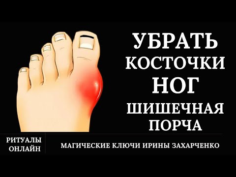 Убрать КОСТОЧКИ на ноге. Порча ШИШЕЧНАЯ. Боль. Воспаление. Бурсит.