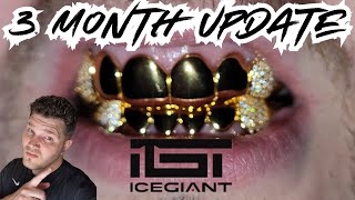 ICEGIANT GRILLZ UPDATE! How Well Do Gold Plated Grillz Hold Up Overtime