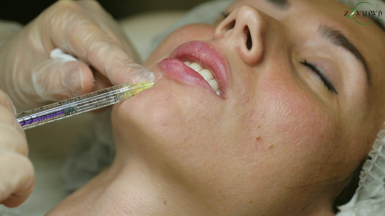 Контурная пластика губ - YouTube