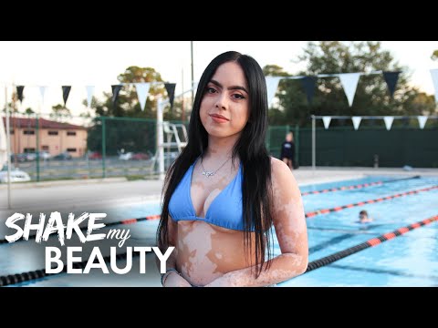 My Vitiligo Stopped Me Wearing Bikinis - Until Now | SHAKE MY BEAUTY