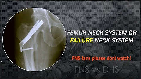 Femoral Neck System (FNS): Is it really Good? Don't watch if you are an FNS fan!