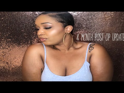 Breast Reduction Journey 