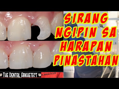 Tooth Filling (Pasta sa Harap na Ngipin) Step by Step #34