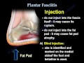 Plantar Fasciitis - Everything You Need To Know - Dr. Nabil Ebraheim