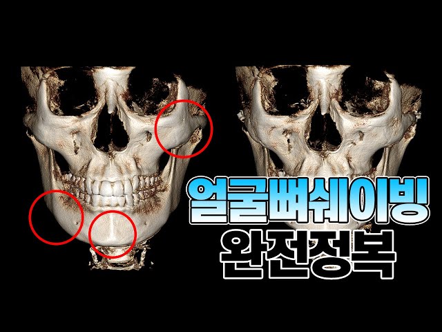 얼굴뼈 쉐이빙 완전정복! #광대쉐이빙 #외측피질쉐이빙 #앞턱쉐이빙