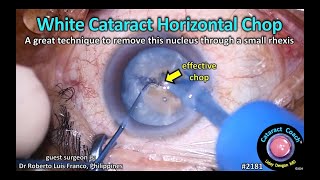 CataractCoach™ 2181: white cataract horizontal chop