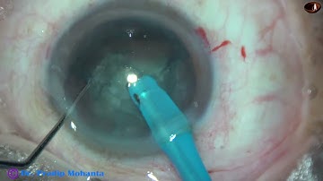 Managing a Cataract with zonular dehiscence  of 4 clock hours : Pradip Mohanta, 14th April, 2021