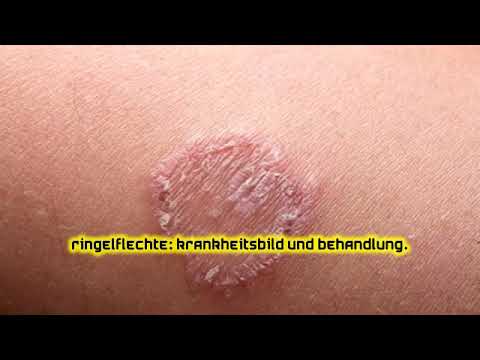 Ringelflechte: Krankheitsbild und Behandlung