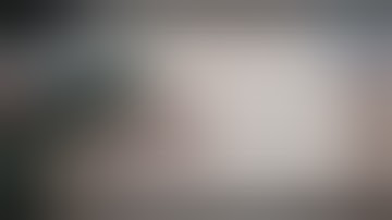 Isolated Tibial fracture | Partial Fibulectomy for Delayed Union | Adamya Hospital videos