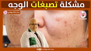 مشكلة تصبغات الوجه مع الدكتور عماد ميزاب Dr imad Mizab