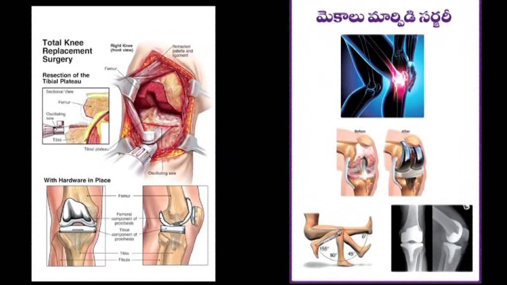 a1orthocare-guntur-dr-ramprasad-kancherla-ms-ortho-youtube