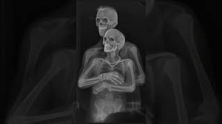 X-ray Lover ❤️ #radiology #xray #shortsfeed #peramedical #viralvideo