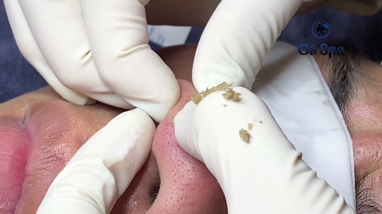 Delay your Vacation: See this Video | ACNE TREATMENT
