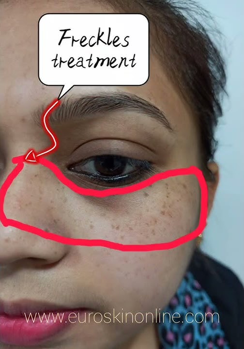 Freckles Removal Treatment