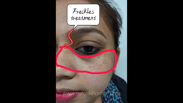 Freckles Removal Treatment - DayDayNews