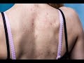 Back Acne (Bacne) Causes and Natural Treatments for Pimples, Blackheads, Hormonal Acne and Scarring