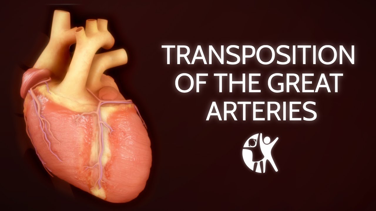 Transposition of the Great Arteries | Diagnosis & Treatment