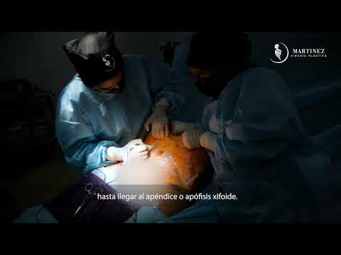 Vídeo: La Dona Es Veia Constantment Enfadada I Insatisfeta Amb La Vida, De Manera Que Va Decidir Sotmetre's A Una Cirurgia Plàstica Per Eliminar La 