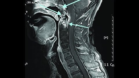 CRANIAL CERVICAL INSTABILITY