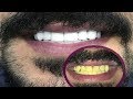 BRIGHT WHITE TEETH AT HOME || 100% WORKS || REMOVE PLAQUE & TARTAR,Effective recipe for lime removal