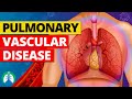 Pulmonary Vascular Disease (Medical Definition) | Quick Explainer Video