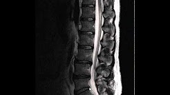 Spinal Arthritis (This Is What It Looks Like)