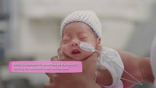 Premature baby  Nutrition and feeding