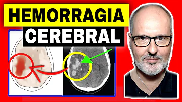 ¿Qué ocurre si no se trata la hemorragia cerebral?