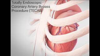 Robotic Totally Endoscopic Coronary Artery Bypass (TECAB)